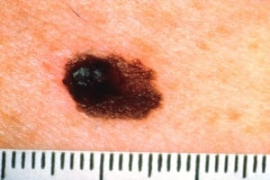 cancer skin asymmetry mole detect asymmetrical half doesn match mark other